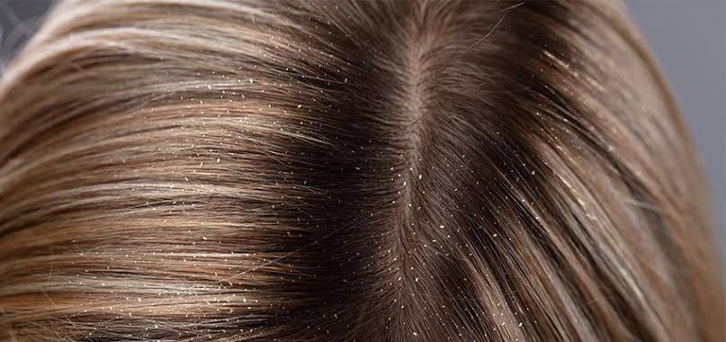 dandruff